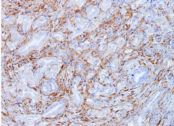 Células tumorales de cáncer de páncreas del modelo Kras del CNIO, mostrando en color marrón la expresión de Galectina-1